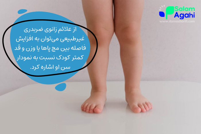 علائم زانوی ضربدری غیرطبیعی در کودکان
