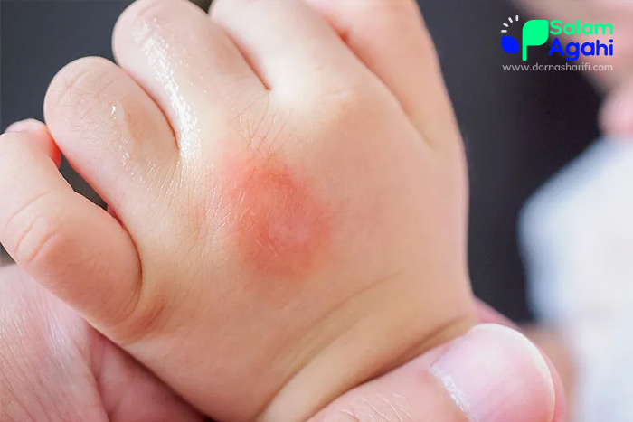 تصویر کهیر روی دست در کودکان
