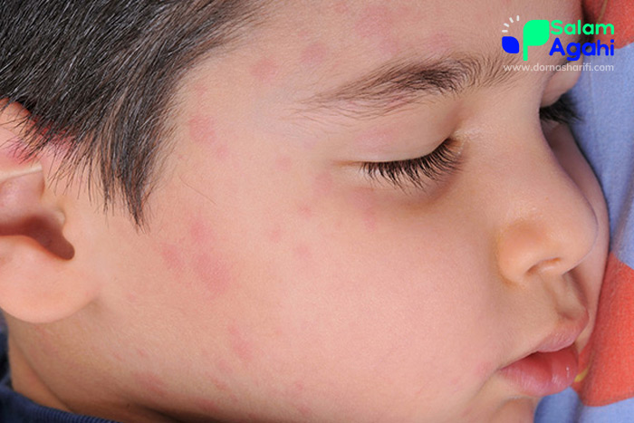 تصویر کهیر صورت در کودکان