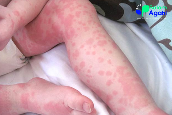 تصویر کهیر پا در کودکان