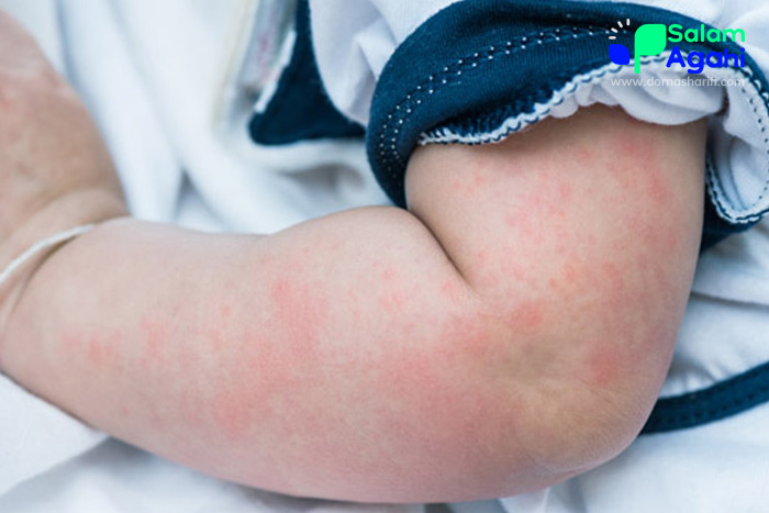 تصویر کهیر ساق دست و بازو در کودکان