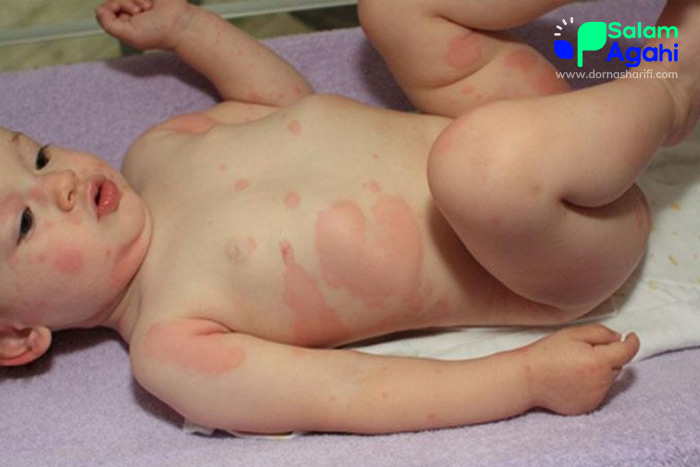 تصویر کهیر بدن در کودکان