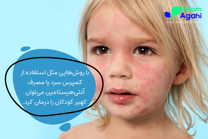 بهترین درمان برای کهیر در کودکان