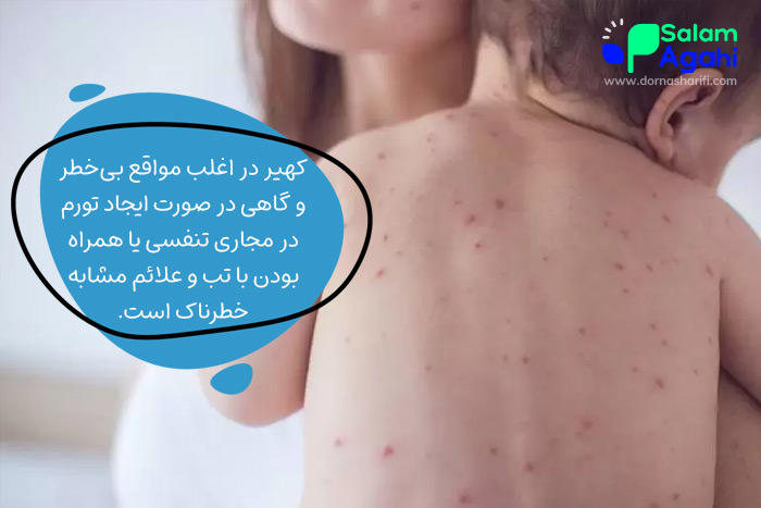 آیا کهیر در کودکان خطرناک است؟