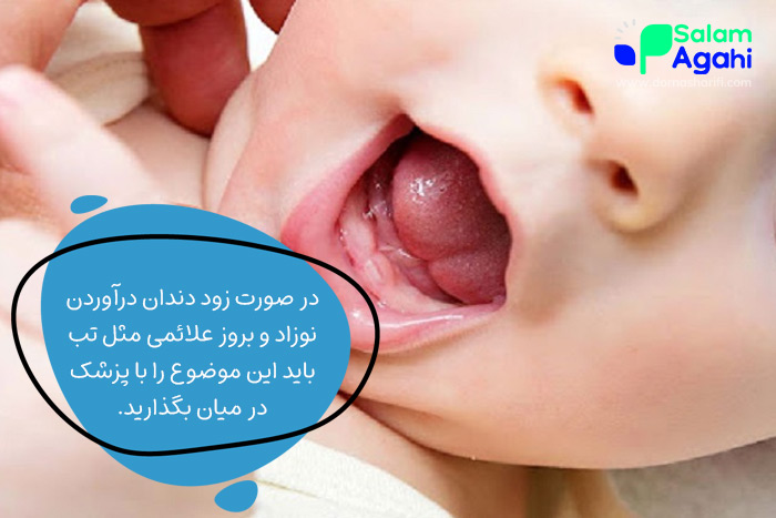 زود دندان درآوردن نوزاد