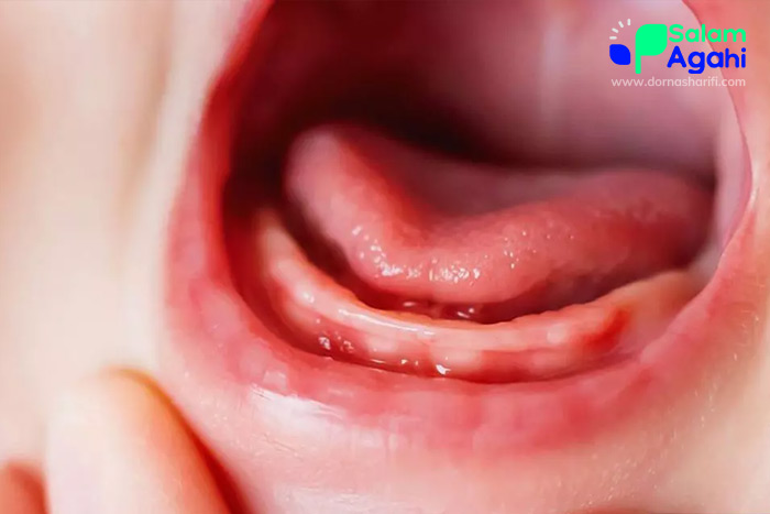 عکس لثه نوزاد هنگام دندان درآوردن