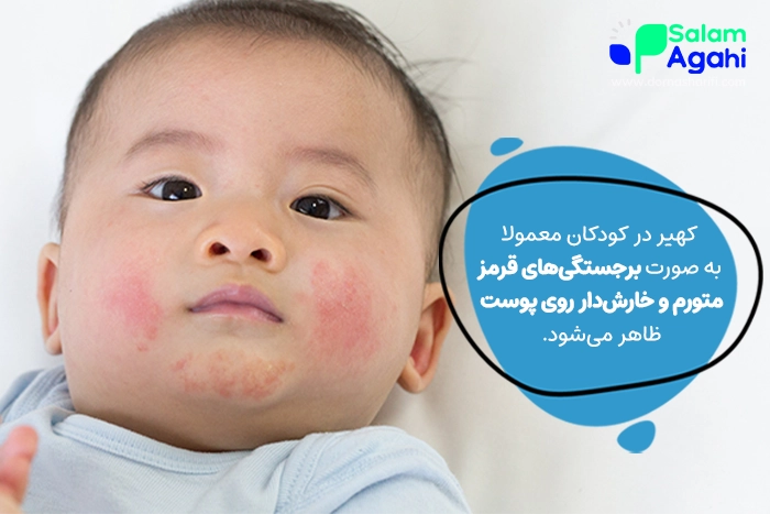 کهیر در کودکان و نوزادان نشانه چیست؟